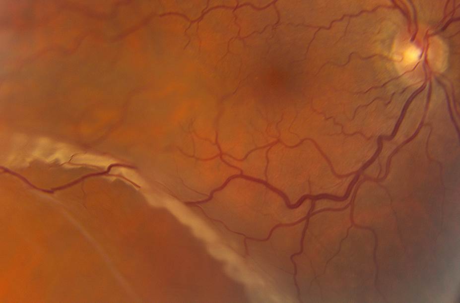 Scan Showing Retinal Detachment in an Eye