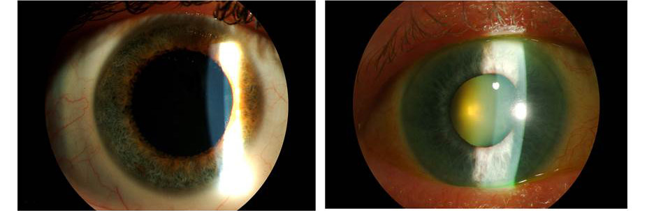 Healthy Eye Compared to One With a Cataract