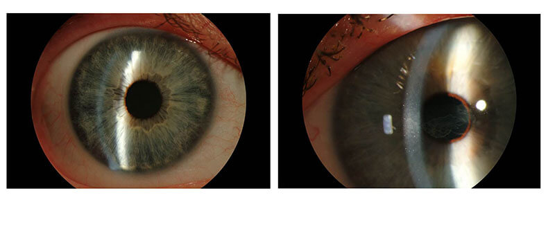 Picture of a Healthy Eye Compared to One With Corneal Disease