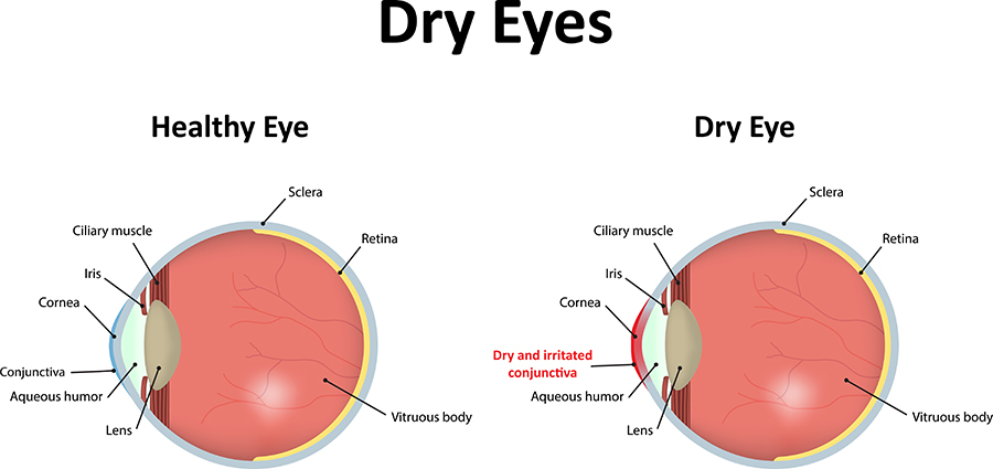 Chart Illustrating a Healthy Eye Compared to one With Dry Eye