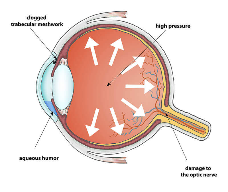 Chart Showing How Glaucoma Affects the Eye