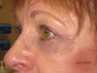Eye After Blepharoplasty Sutery